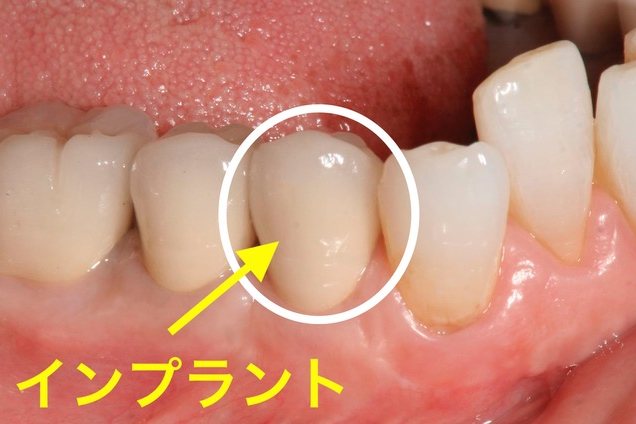 右下小臼歯部のインプラント治療後の口腔内写真