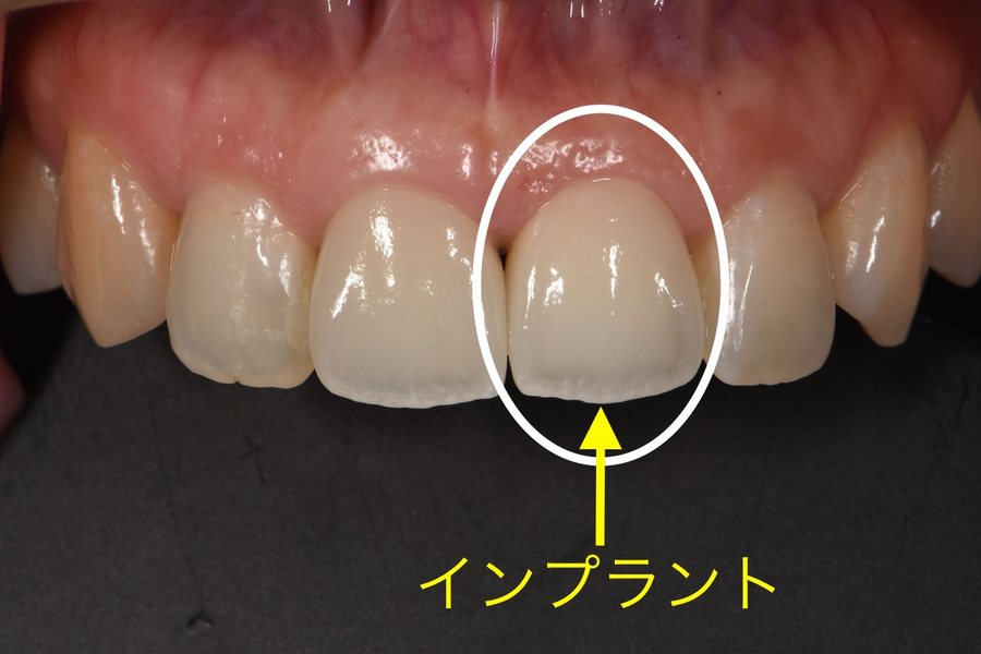 左上前歯部のインプラント治療後の口腔内写真