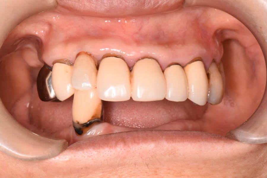 下顎全体のインプラント治療前の口腔内写真